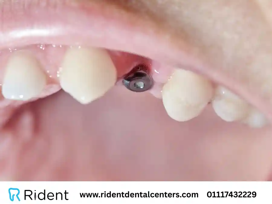 تكلفة زراعة الضرس الواحد